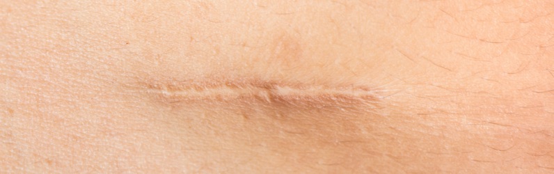 Normal scar: flat and pale 