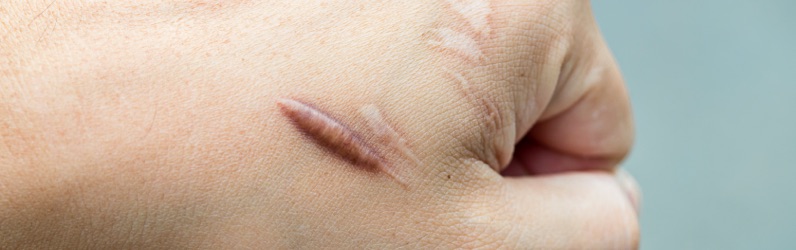 Keloid scar: raised and large, occasionally itchy and painful
