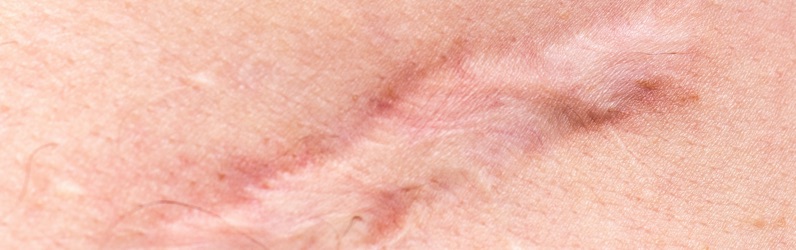 Hypertrophic scar: raised and occasionally itchy and painful
