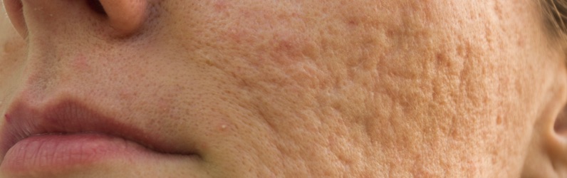 Atrophic scar:  sunken scars from severe acne

